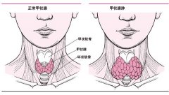 甲状腺结节的相关问题?